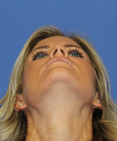 Rhinoplasty 0327 – Click HERE for more views after photo. Individual results may vary.