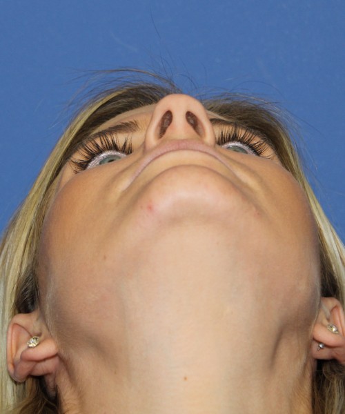 Rhinoplasty 0327 – Click HERE for more views before photo. Individual results may vary.