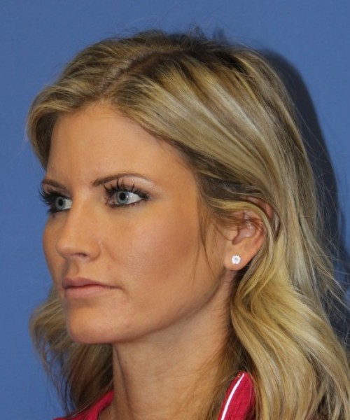 Rhinoplasty 0327 – Click HERE for more views after photo. Individual results may vary.