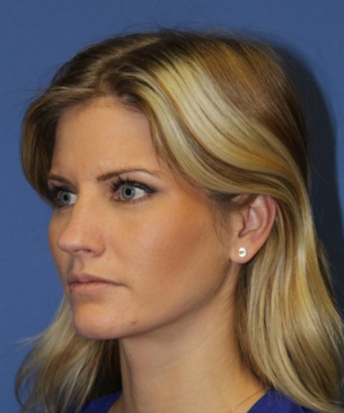 Rhinoplasty 0327 – Click HERE for more views before photo. Individual results may vary.