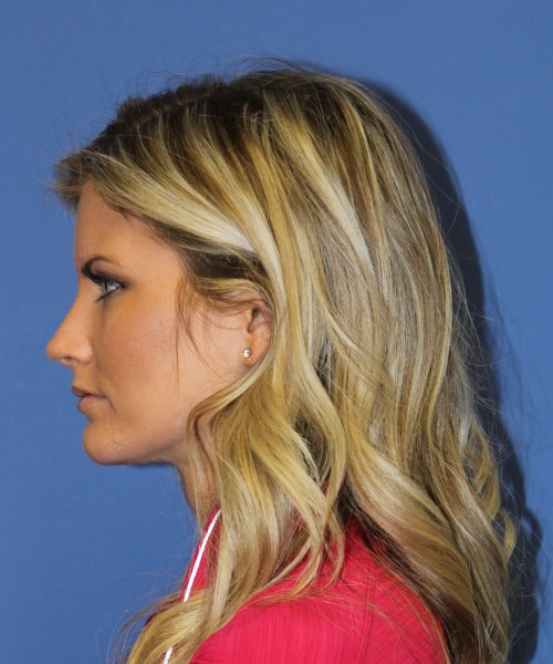 Rhinoplasty 0327 – Click HERE for more views after photo. Individual results may vary.