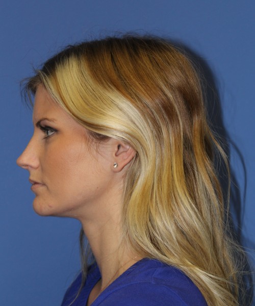 Rhinoplasty 0327 – Click HERE for more views before photo. Individual results may vary.