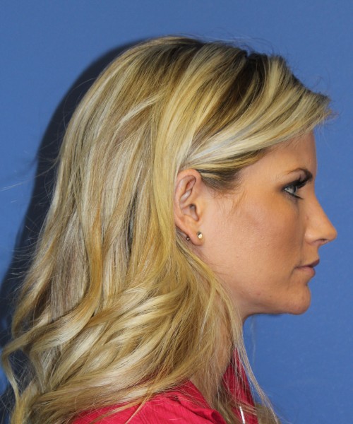 Rhinoplasty 0327 – Click HERE for more views after photo. Individual results may vary.