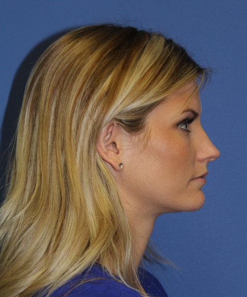 Rhinoplasty 0327 – Click HERE for more views before photo. Individual results may vary.
