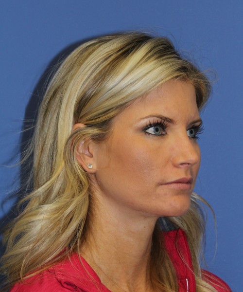 Rhinoplasty 0327 – Click HERE for more views after photo. Individual results may vary.
