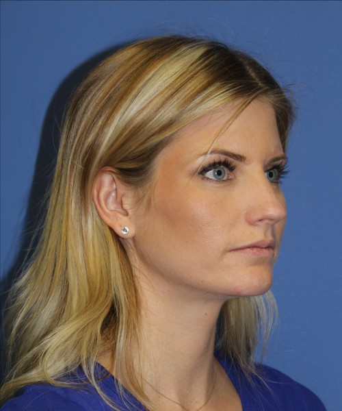 Rhinoplasty 0327 – Click HERE for more views before photo. Individual results may vary.