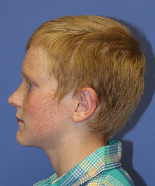 Otoplasty (Ear Pinning) 3912 – Click HERE for more views after photo. Individual results may vary.
