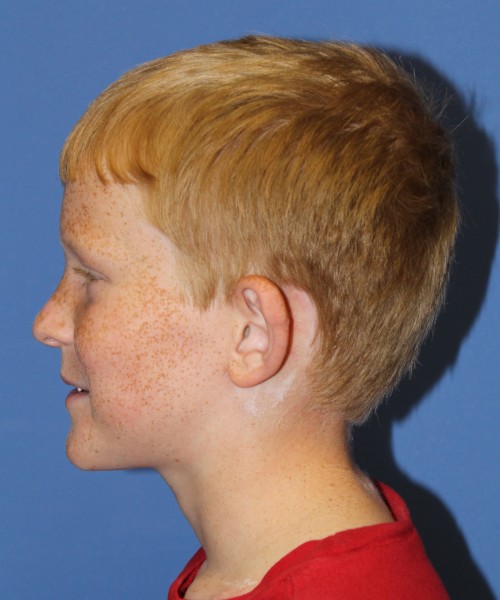 Otoplasty (Ear Pinning) 3912 – Click HERE for more views before photo. Individual results may vary.