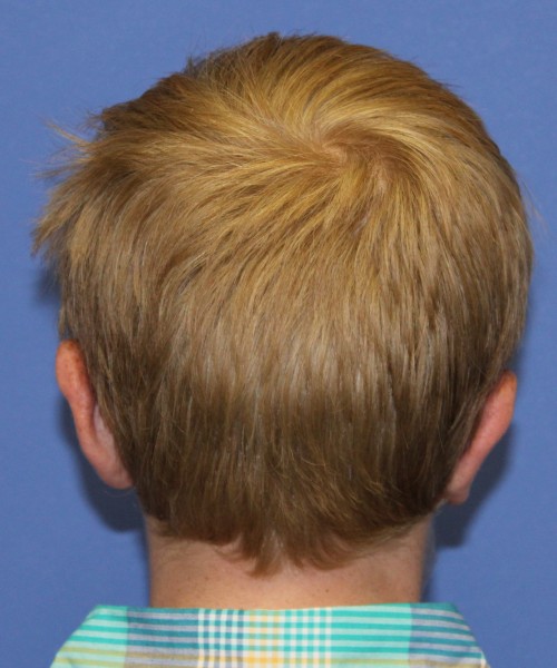 Otoplasty (Ear Pinning) 3912 – Click HERE for more views after photo. Individual results may vary.