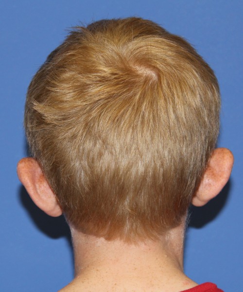 Otoplasty (Ear Pinning) 3912 – Click HERE for more views before photo. Individual results may vary.