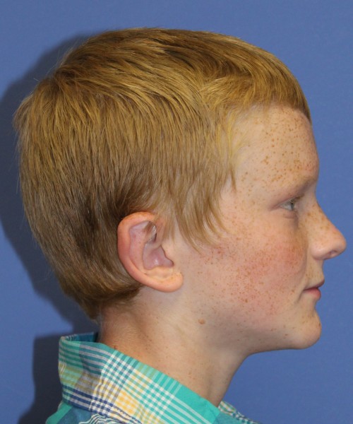 Otoplasty (Ear Pinning) 3912 – Click HERE for more views after photo. Individual results may vary.