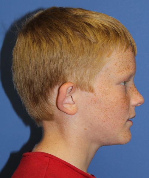 Otoplasty (Ear Pinning) 3912 – Click HERE for more views before photo. Individual results may vary.