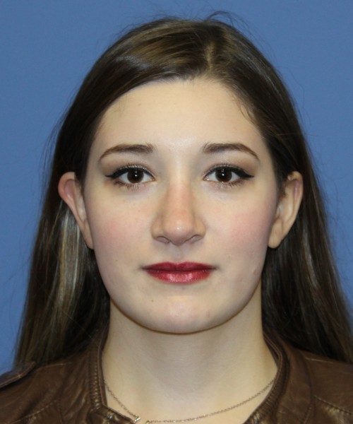 Revision Rhinoplasty 3939 – Click HERE for more views after photo. Individual results may vary.