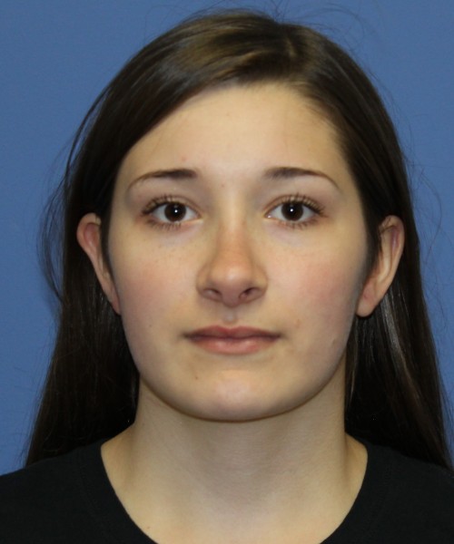 Revision Rhinoplasty 3939 – Click HERE for more views before photo. Individual results may vary.