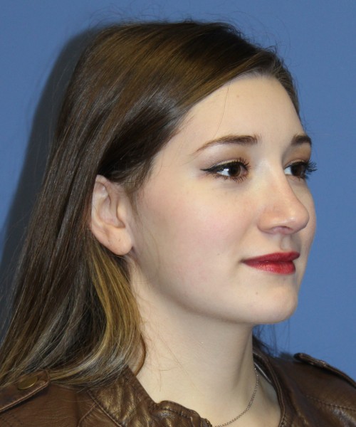 Revision Rhinoplasty 3939 – Click HERE for more views after photo. Individual results may vary.