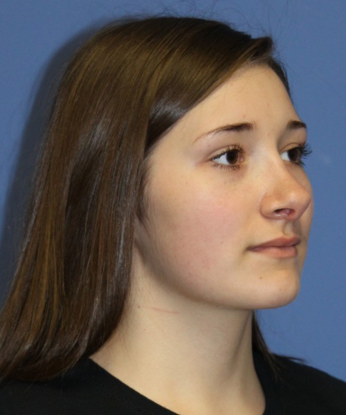 Revision Rhinoplasty 3939 – Click HERE for more views before photo. Individual results may vary.