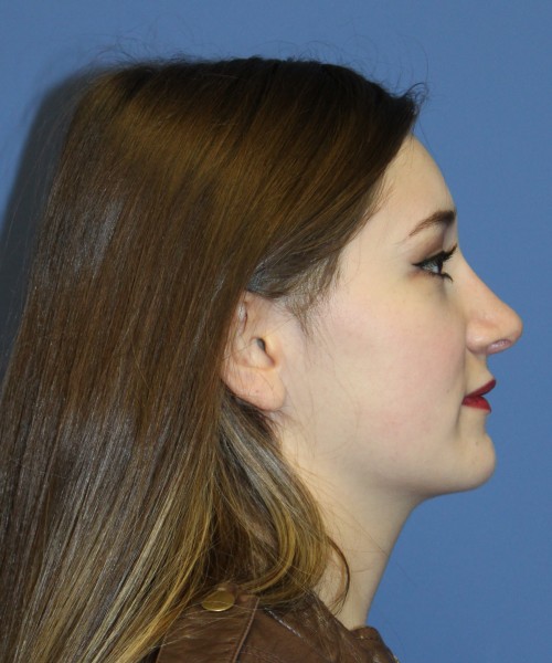 Revision Rhinoplasty 3939 – Click HERE for more views after photo. Individual results may vary.