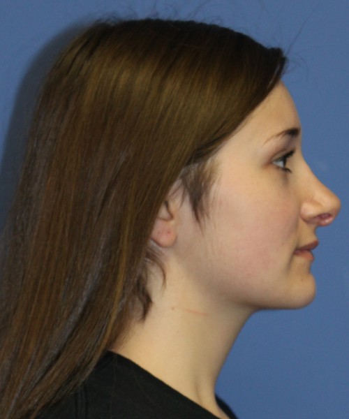 Revision Rhinoplasty 3939 – Click HERE for more views before photo. Individual results may vary.