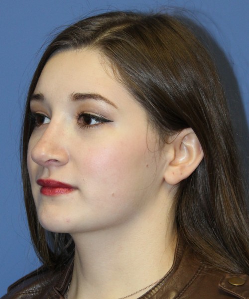 Revision Rhinoplasty 3939 – Click HERE for more views after photo. Individual results may vary.