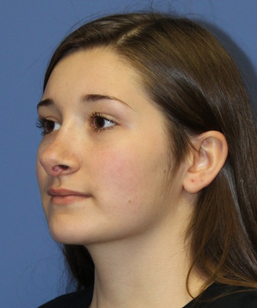 Revision Rhinoplasty 3939 – Click HERE for more views before photo. Individual results may vary.