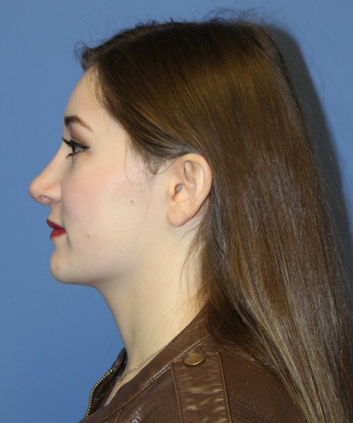 Revision Rhinoplasty 3939 – Click HERE for more views after photo. Individual results may vary.