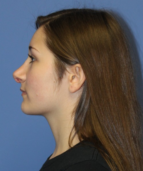 Revision Rhinoplasty 3939 – Click HERE for more views before photo. Individual results may vary.