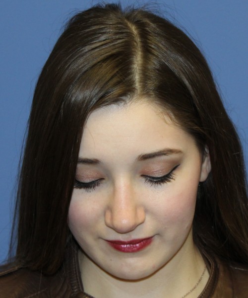 Revision Rhinoplasty 3939 – Click HERE for more views after photo. Individual results may vary.