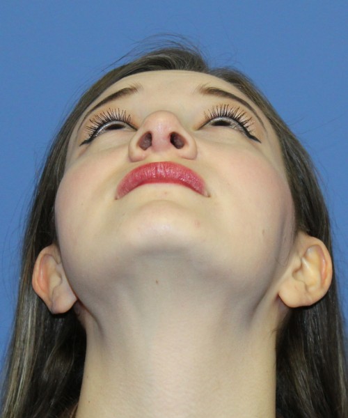 Revision Rhinoplasty 3939 – Click HERE for more views after photo. Individual results may vary.