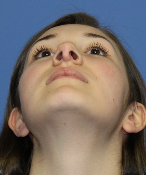 Revision Rhinoplasty 3939 – Click HERE for more views before photo. Individual results may vary.