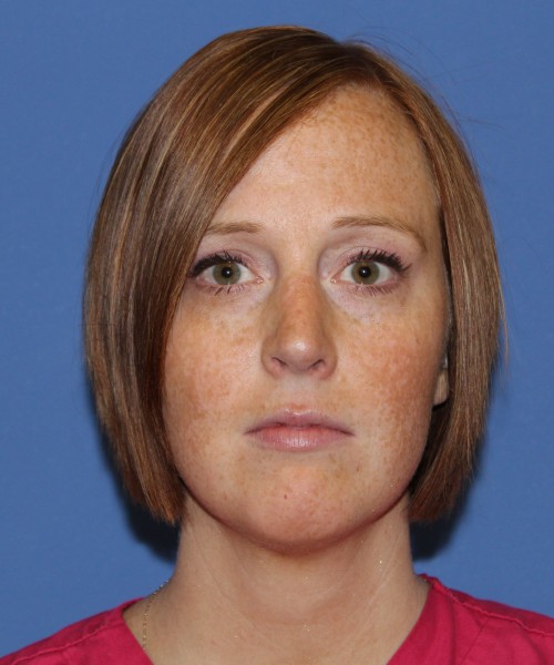 Revision Rhinoplasty 3995 – Click HERE for more views after photo. Individual results may vary.