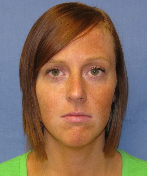 Revision Rhinoplasty 3995 – Click HERE for more views before photo. Individual results may vary.