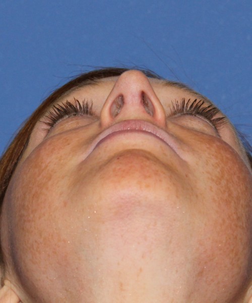 Revision Rhinoplasty 3995 – Click HERE for more views after photo. Individual results may vary.