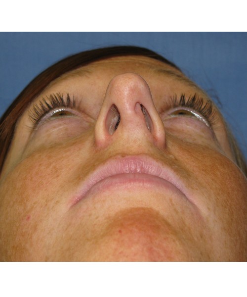 Revision Rhinoplasty 3995 – Click HERE for more views before photo. Individual results may vary.