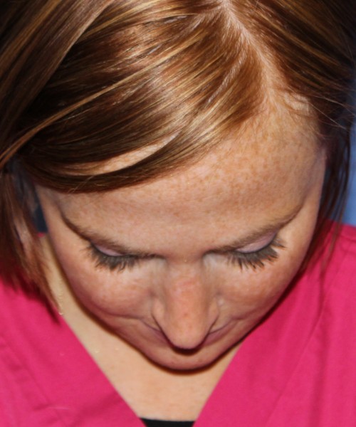 Revision Rhinoplasty 3995 – Click HERE for more views after photo. Individual results may vary.