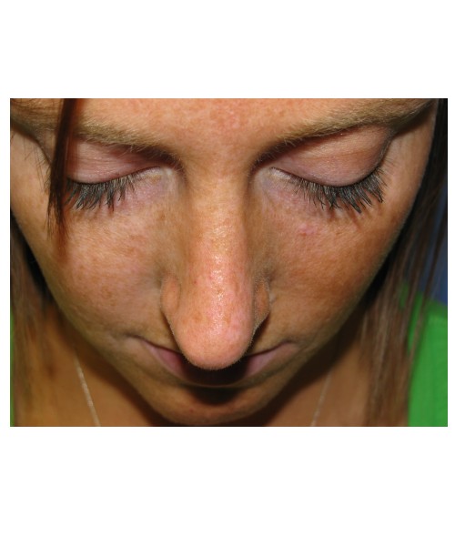 Revision Rhinoplasty 3995 – Click HERE for more views before photo. Individual results may vary.