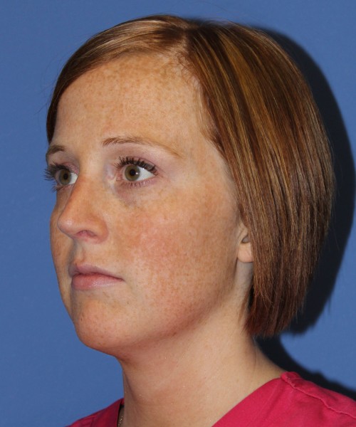 Revision Rhinoplasty 3995 – Click HERE for more views after photo. Individual results may vary.