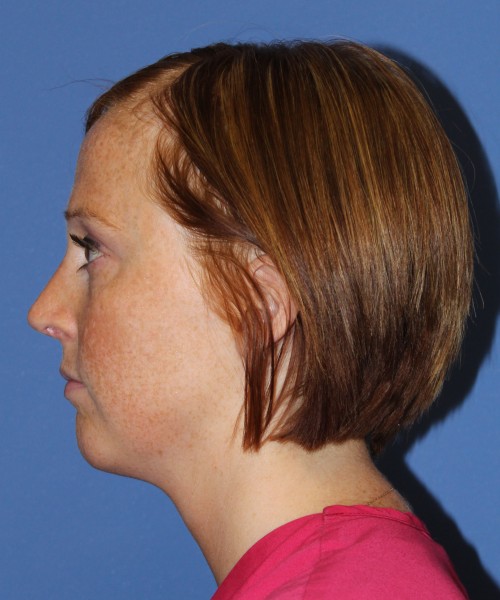 Revision Rhinoplasty 3995 – Click HERE for more views after photo. Individual results may vary.