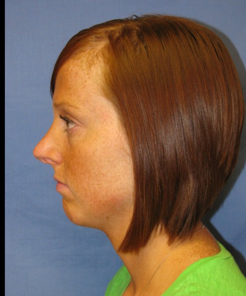 Revision Rhinoplasty 3995 – Click HERE for more views before photo. Individual results may vary.