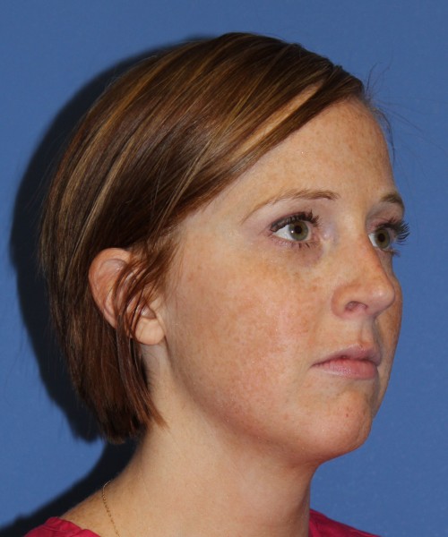 Revision Rhinoplasty 3995 – Click HERE for more views after photo. Individual results may vary.