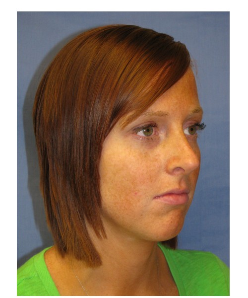 Revision Rhinoplasty 3995 – Click HERE for more views before photo. Individual results may vary.