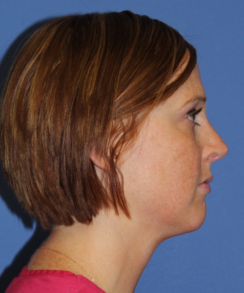 Revision Rhinoplasty 3995 – Click HERE for more views after photo. Individual results may vary.
