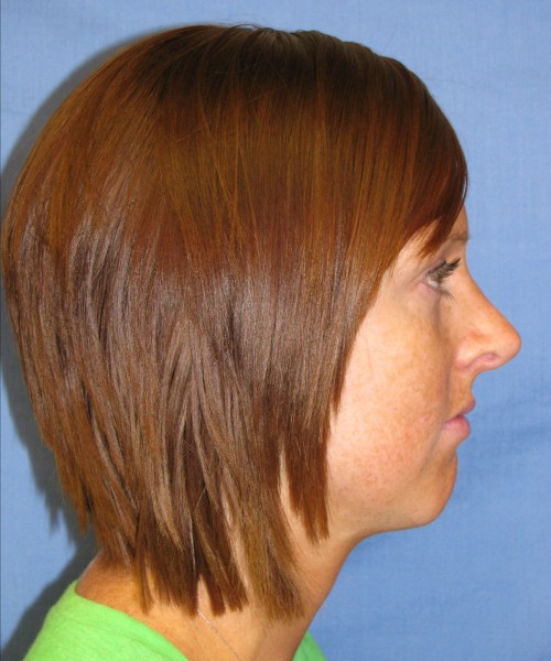 Revision Rhinoplasty 3995 – Click HERE for more views before photo. Individual results may vary.