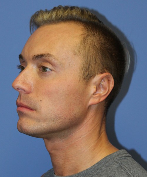 Otoplasty (Ear Pinning) 3993 – Click HERE for more views after photo. Individual results may vary.