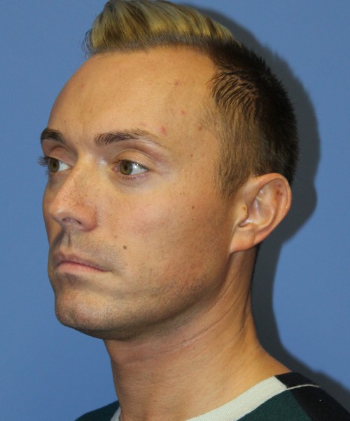 Otoplasty (Ear Pinning) 3993 – Click HERE for more views before photo. Individual results may vary.
