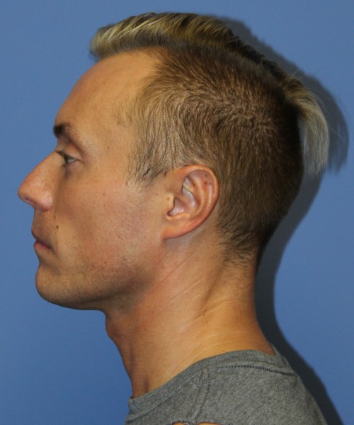 Otoplasty (Ear Pinning) 3993 – Click HERE for more views after photo. Individual results may vary.