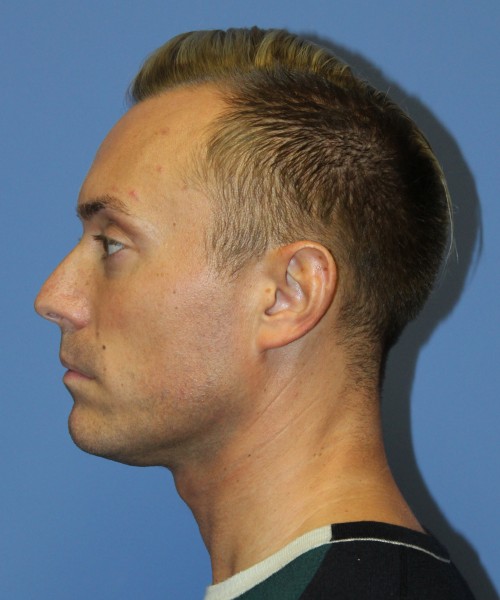 Otoplasty (Ear Pinning) 3993 – Click HERE for more views before photo. Individual results may vary.