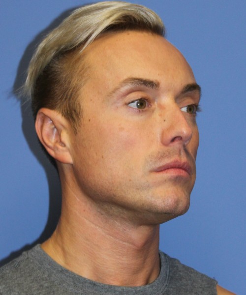 Otoplasty (Ear Pinning) 3993 – Click HERE for more views after photo. Individual results may vary.