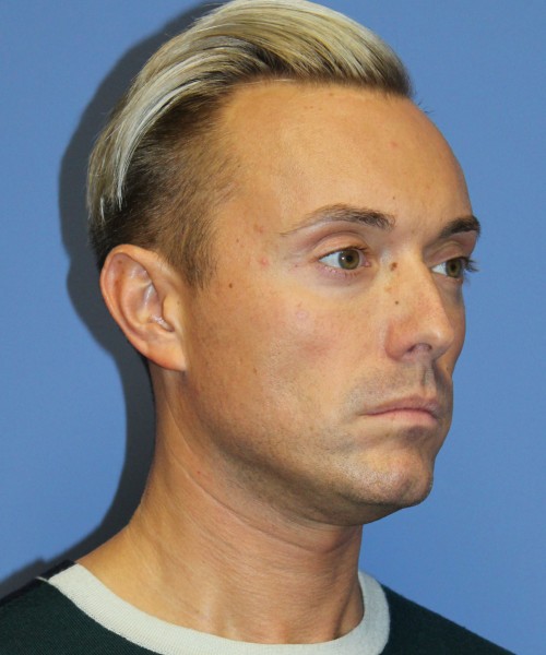 Otoplasty (Ear Pinning) 3993 – Click HERE for more views before photo. Individual results may vary.