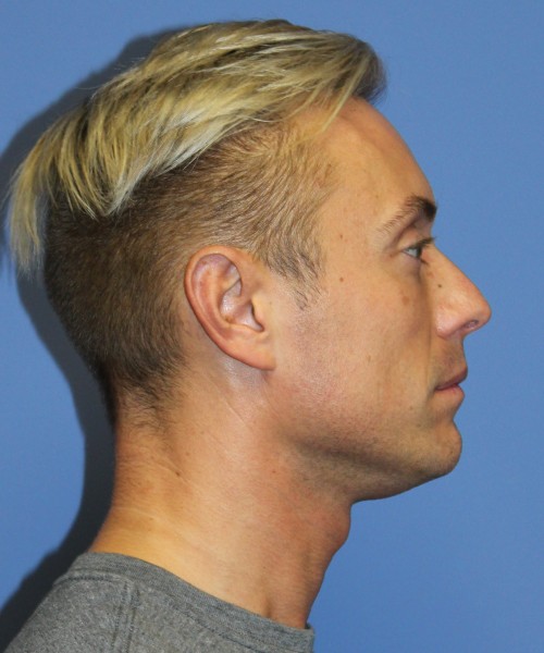 Otoplasty (Ear Pinning) 3993 – Click HERE for more views after photo. Individual results may vary.