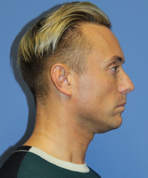 Otoplasty (Ear Pinning) 3993 – Click HERE for more views before photo. Individual results may vary.